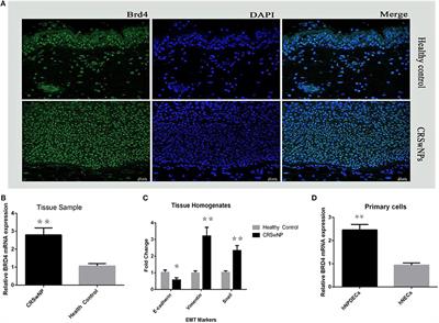 Correlation of Bromodomain Protein BRD4 Expression With Epithelial–Mesenchymal Transition and Disease Severity in Chronic Rhinosinusitis With Nasal Polyps